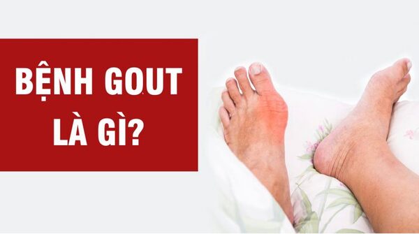 Gout là gì