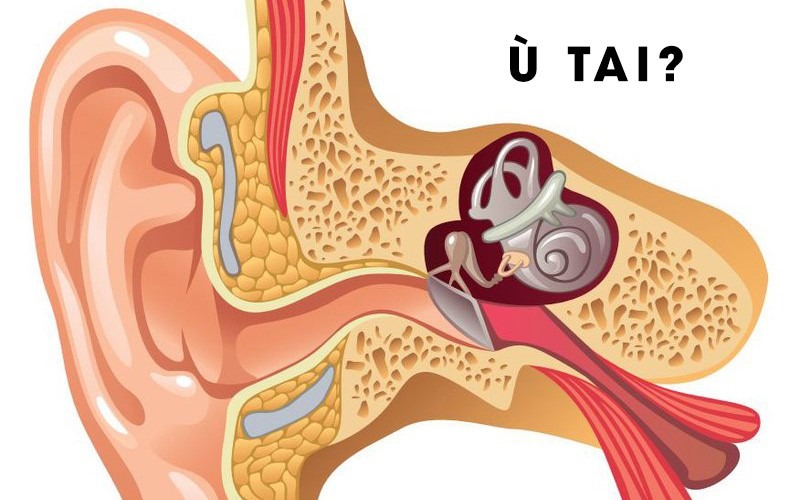 Ù tai có thể xuất phát từ nhiều nguyên nhân như tiếng ồn lớn, ráy tai tích tụ, viêm tai, căng thẳng hoặc thay đổi áp suất. 